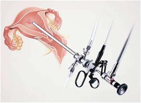 什么是宫腔镜？宫腔镜可以治疗哪些疾病？