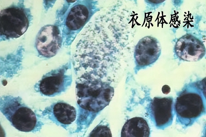 性病中的“NO.1”，全球每年新发感染约9200万例​，你知道多少