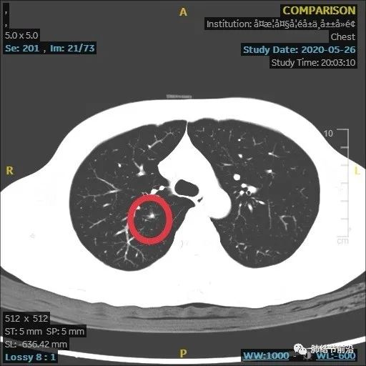 炎症引起的肺实性结节生长速度,肺部结节影像学读片讲解视频