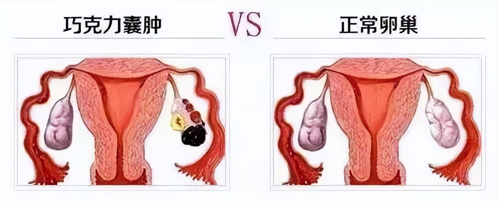 什么是卵巢囊肿该怎么预防呢,卵巢囊肿怎样引起的