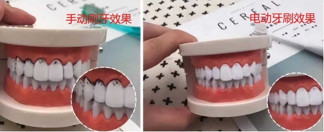 儿童电动牙刷的危害弊端科普,电动牙刷刷牙的弊端