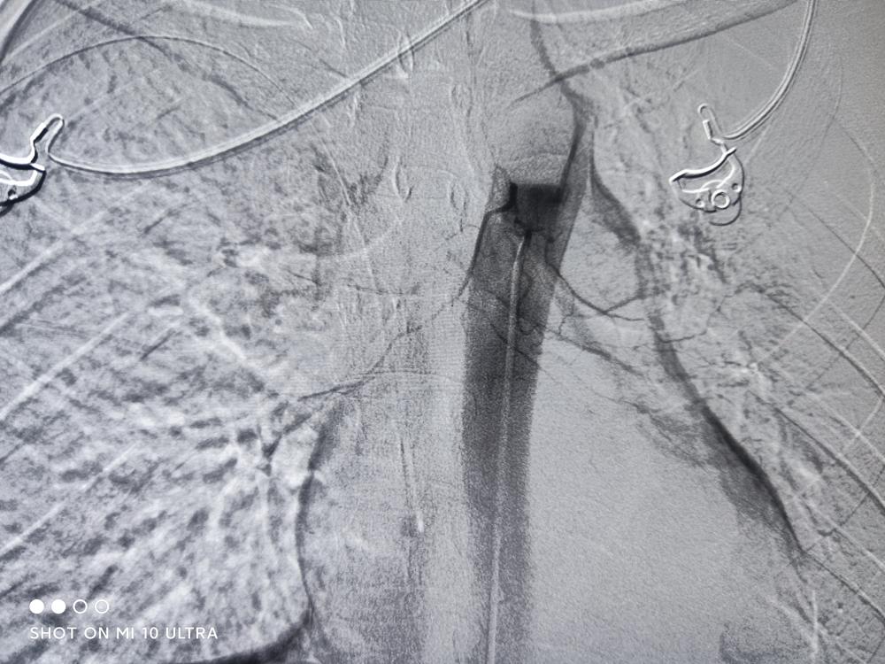肺部肿瘤一年长多大,肺部长了鸡蛋大的肿瘤严重吗