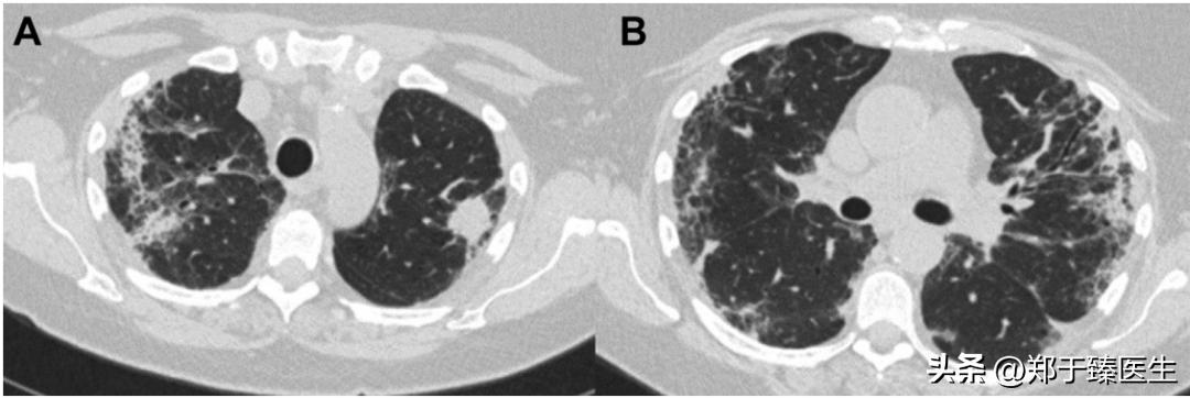 当癌症遇到新冠会怎么样,当癌症病人感染新冠病毒怎么办
