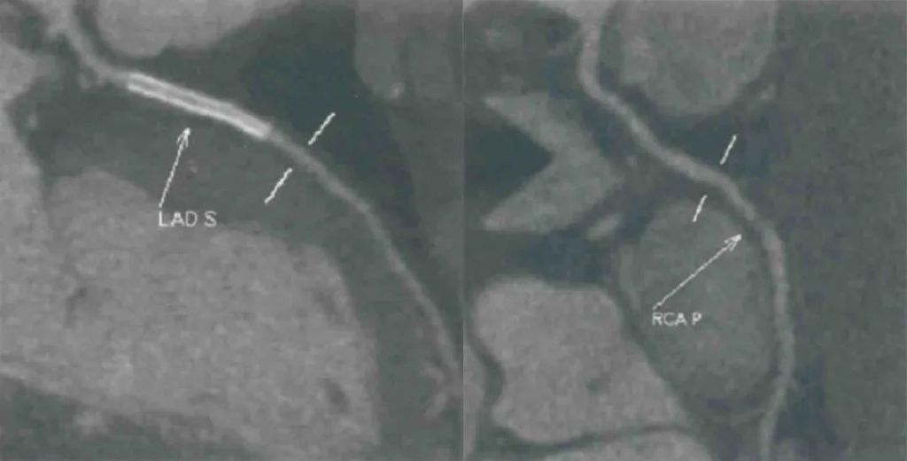 急诊PCI指南,急诊pci治疗费用