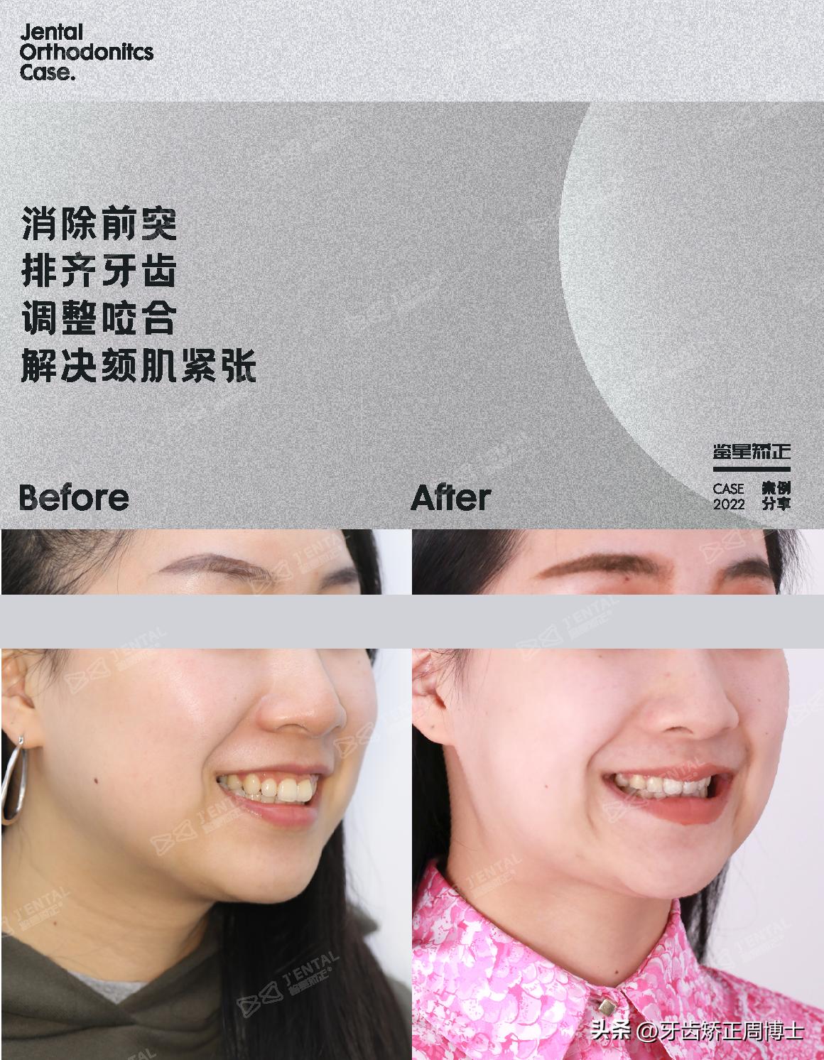 即刻种植即刻修复免受缺牙的痛苦,缺牙不补倾斜矫正价钱