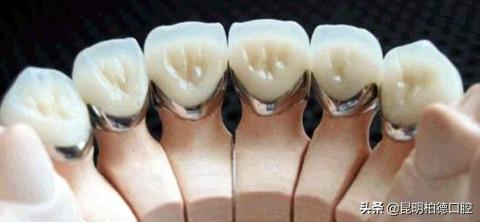 牙齿掉了一半做烤瓷牙全过程,有关牙齿那些事儿