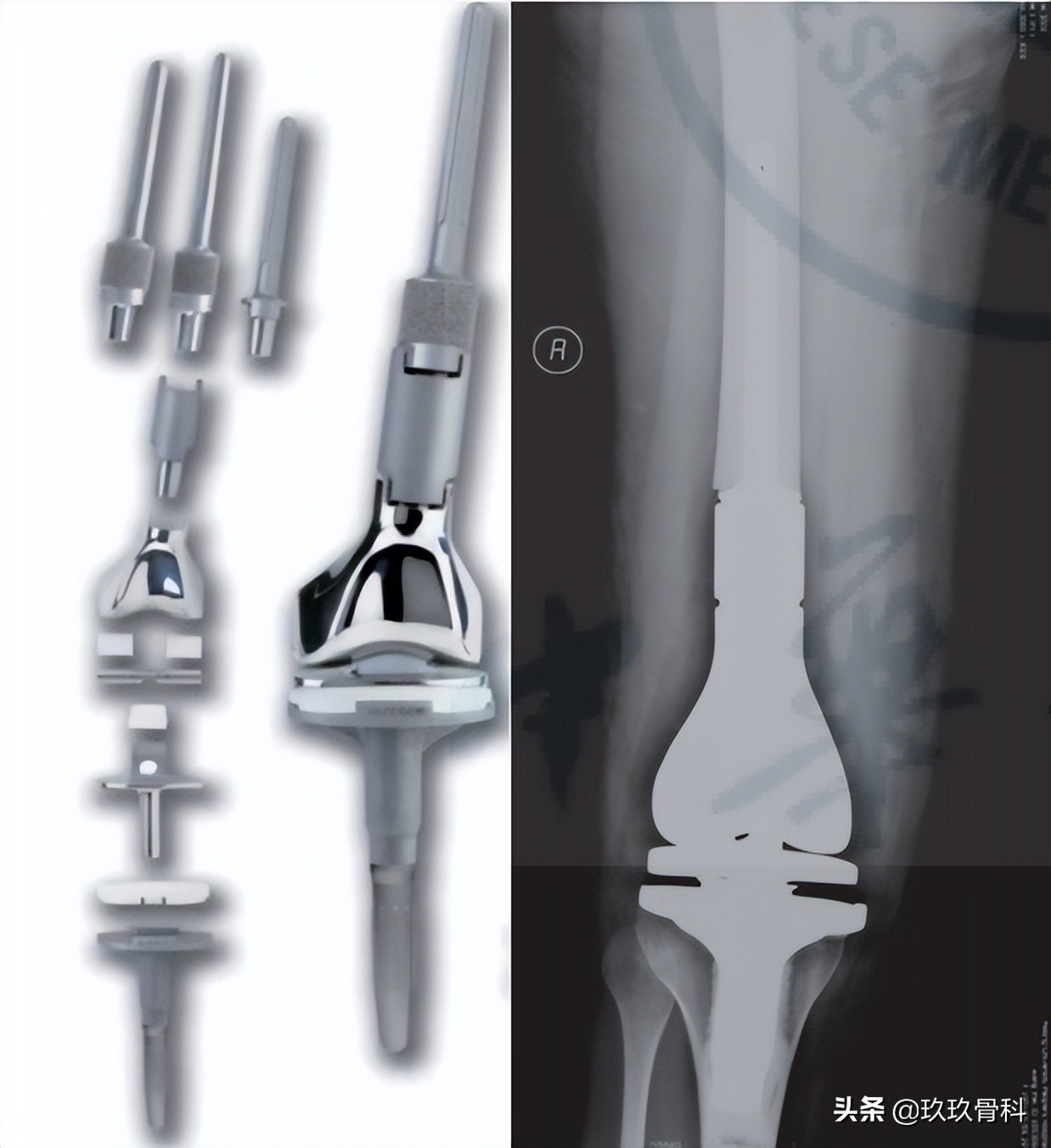 人工关节假体的诞生和发展,国产肿瘤型人工关节假体
