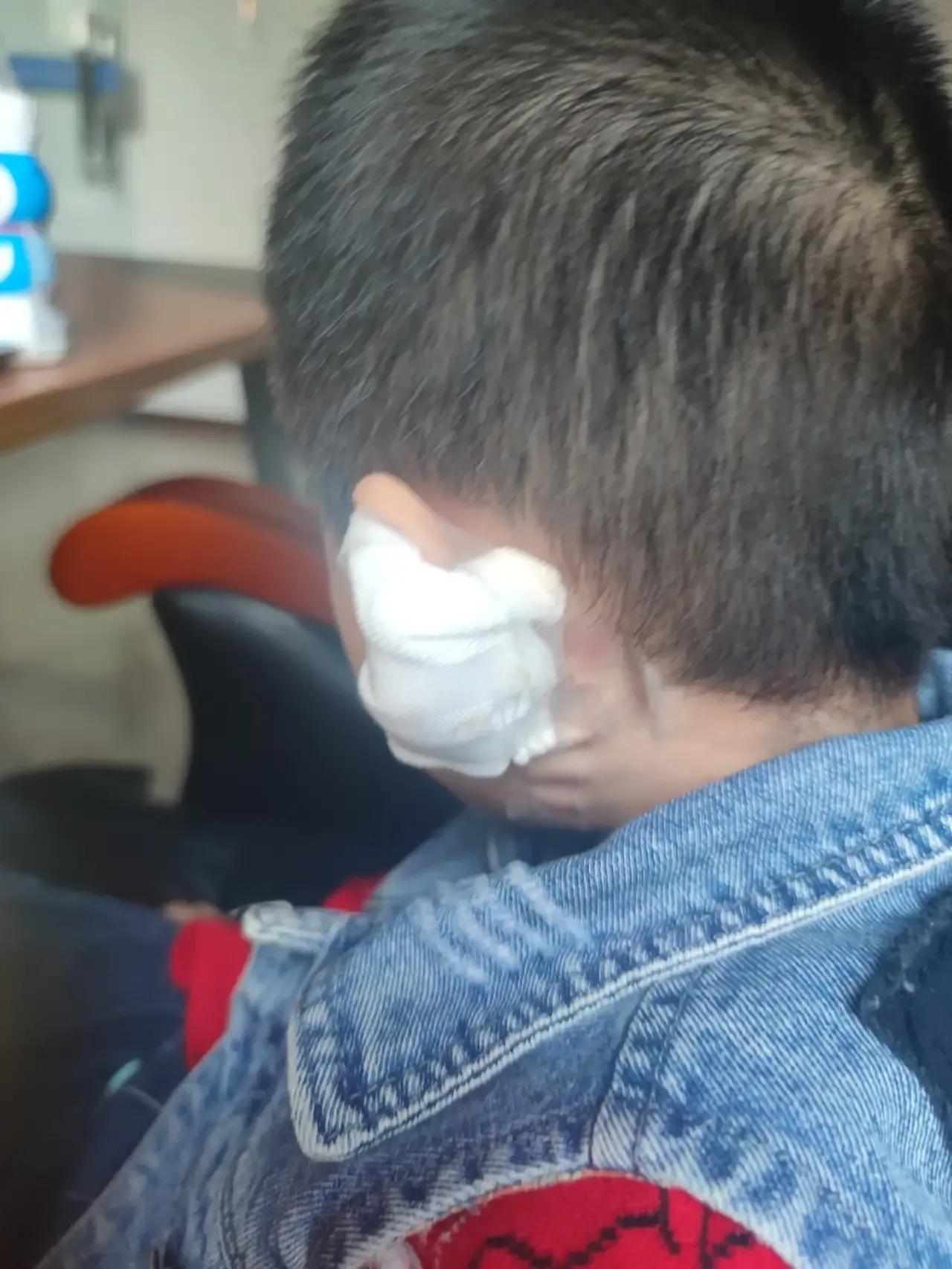 宝宝在幼儿园受伤缝针合理赔偿,幼儿园摔伤缝针赔偿标准