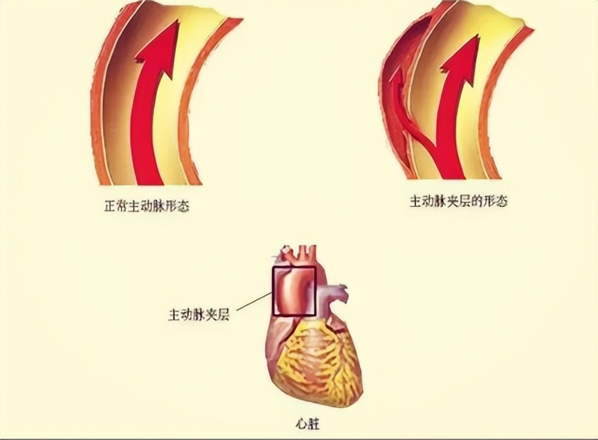 主动脉夹层破裂急救能电击抢救吗,河南胸科医院主动脉夹层急救