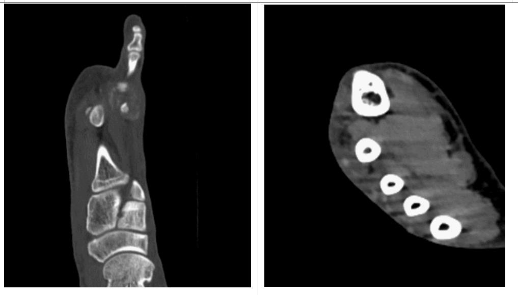 痛风石最简单的解释,世界痛风日是哪一天