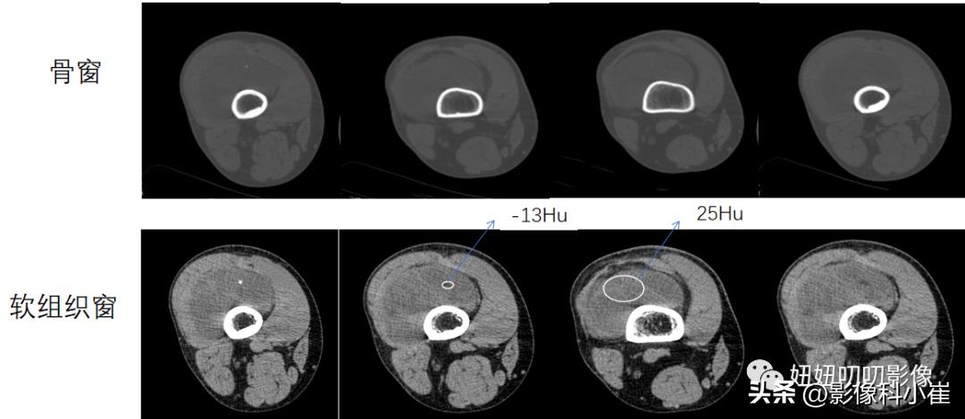 软组织肿块形成原因,软组织肿块怎么治最好