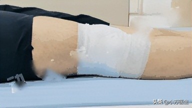 后交叉韧带重建术后康复计划,后交叉韧带重建术后康复角度指导