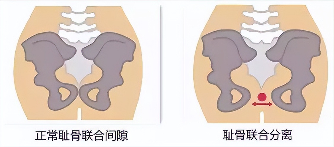 孕晚期不会耻骨痛是没有入盆吗,孕晚期耻骨痛是胎儿入盆了么