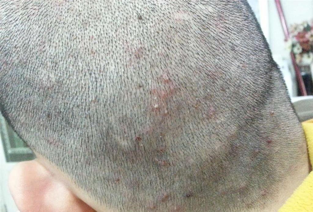 为什么头皮上有小疙瘩和脓包,头皮长疙瘩和脓包是怎么回事