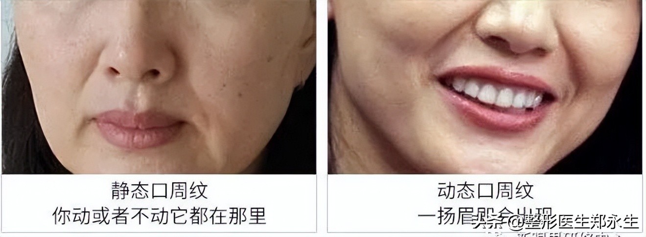 干裂起皮、涂口红不好看,可能是你的嘴唇变老了!唇部老化怎么办