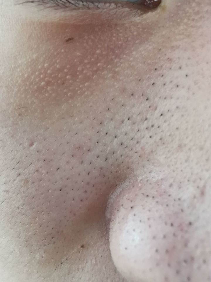 真黑头假黑头傻傻分不清楚，怎么去黑头？