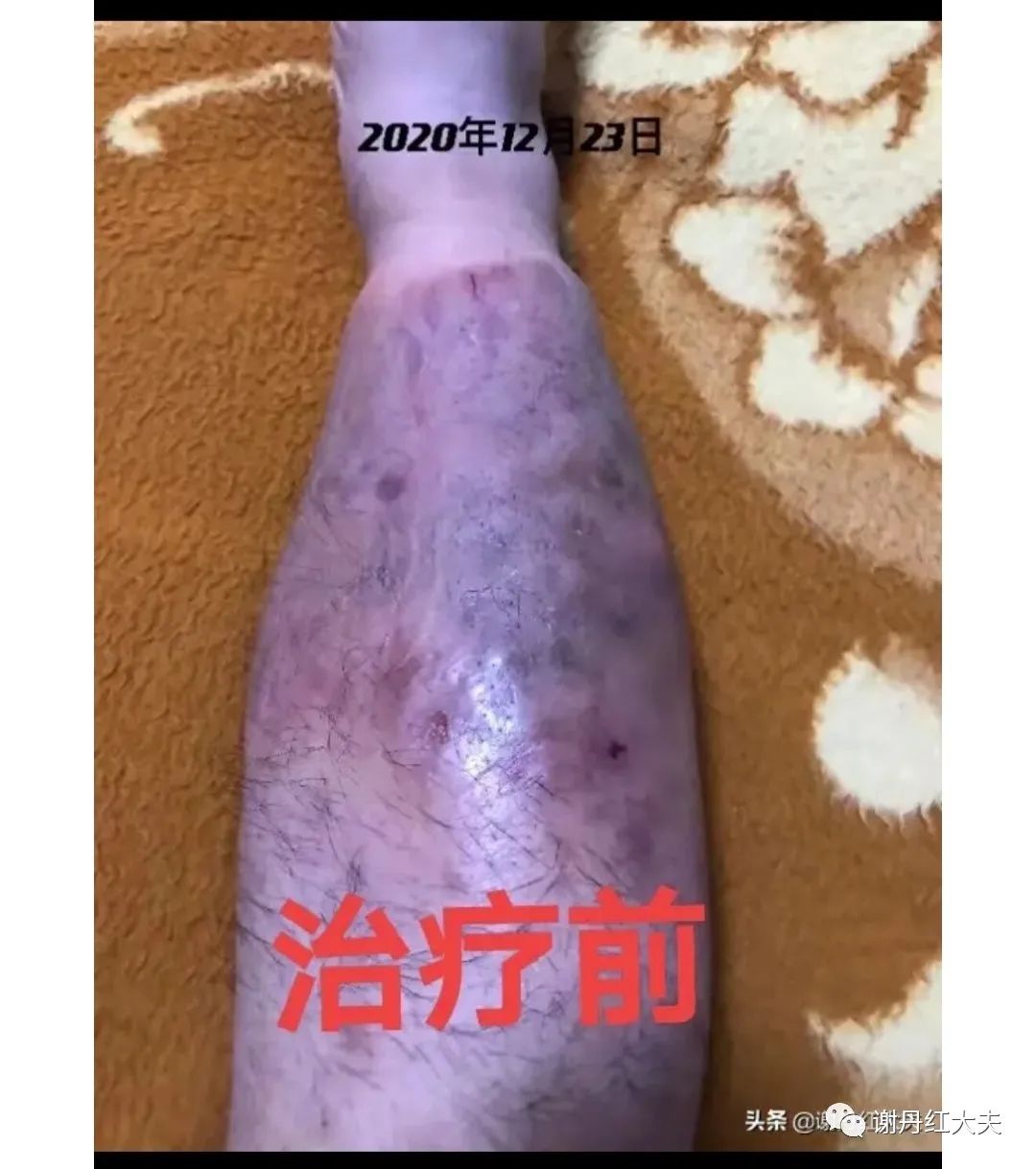 胫前黏液性水肿见于哪些病,胫前黏液性水肿为凹陷性水肿吗