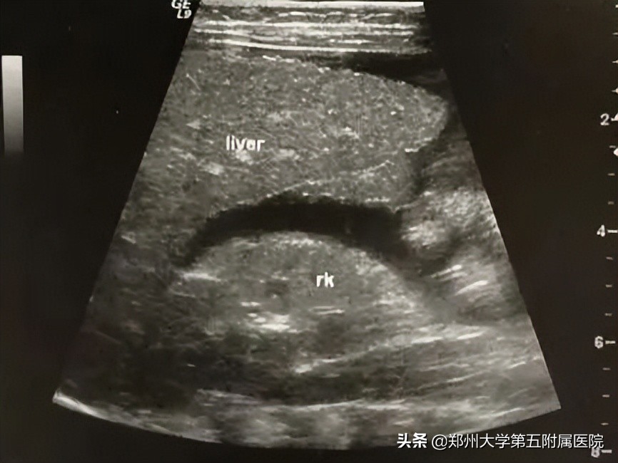 黄疸患者如何用超声诊断与鉴别,小儿黄疸超声筛查