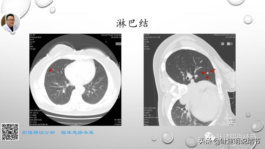 在《一脉阳光》呼吸影像诊断专题培训班上的讲课PPT（第一部分）