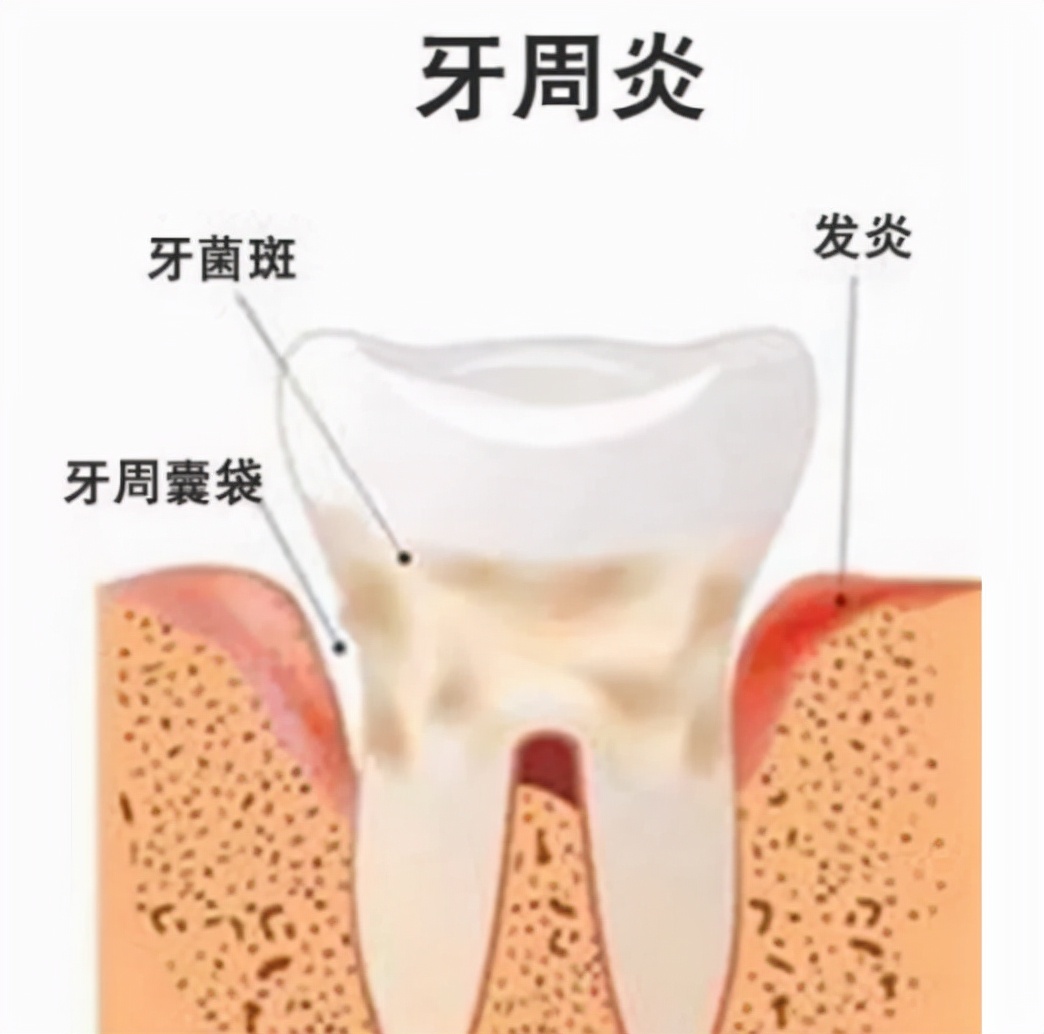 为什么洗完牙后牙缝会变大,牙医说洗牙后牙缝变大