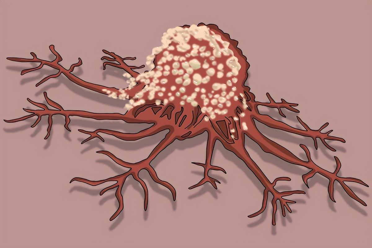 癌细胞怕热能消灭吗,癌细胞怕热艾灸能热烫死癌细胞吗