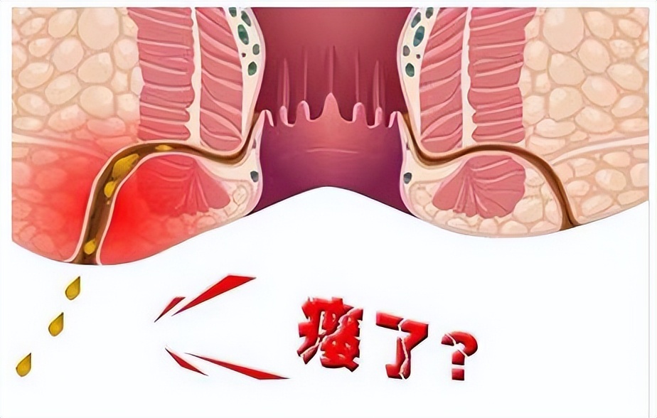 什么是肛瘘都有哪些症状,什么是肛瘘是怎么回事