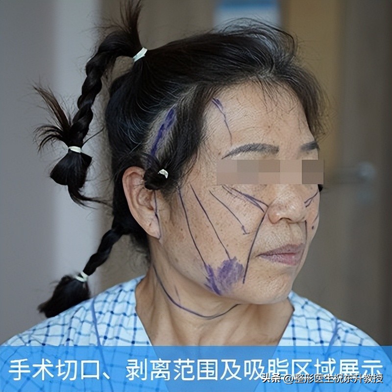 做拉皮手术的朋友感言,拉皮手术大实话听完你还敢做吗