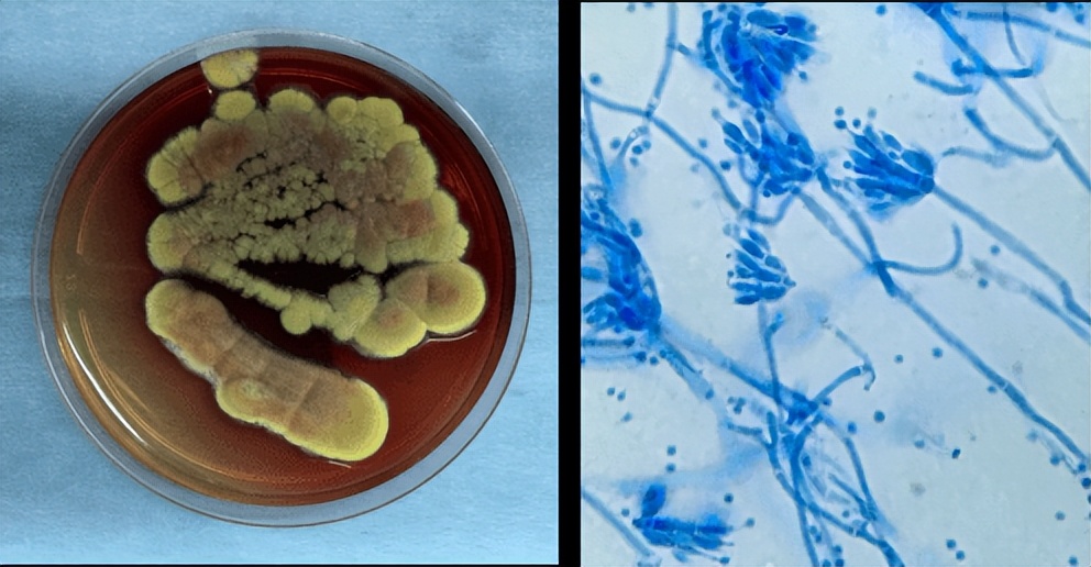 女子胸痛去医院检查出癌症,胸痛医生怀疑是肺癌