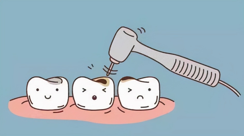 龋齿小洞不补,龋齿不及时补后果