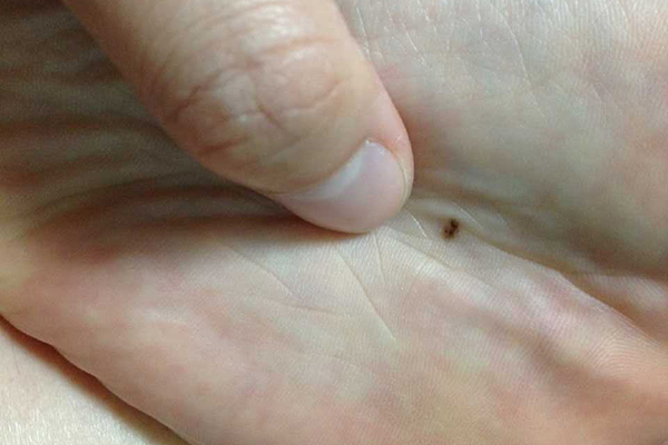 身上有癌的10个皮肤征兆,身体内有癌皮肤有几种表现