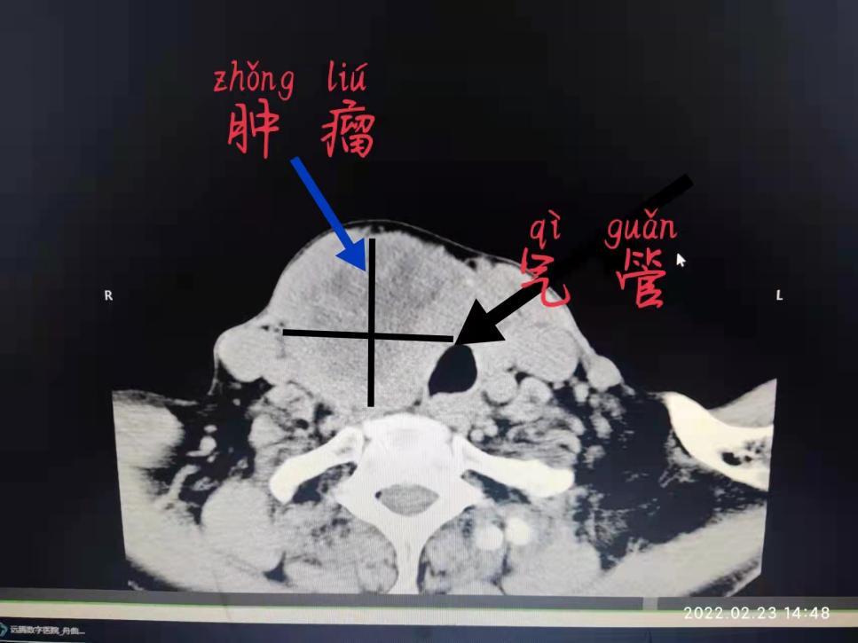 胸骨后甲状腺肿手术是大手术吗,胸骨下甲状腺切除术步骤