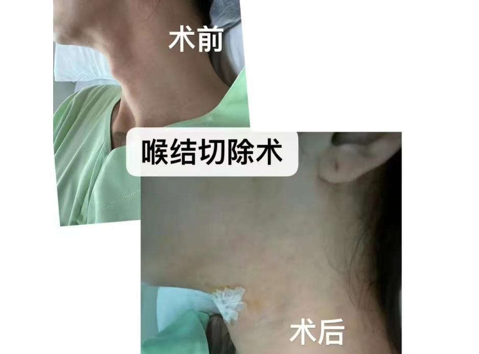 泰国手术变性网红,泰国做变性手术新闻