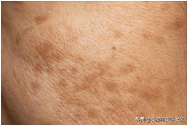 褐斑是什么病,褐斑是什么病怎么治