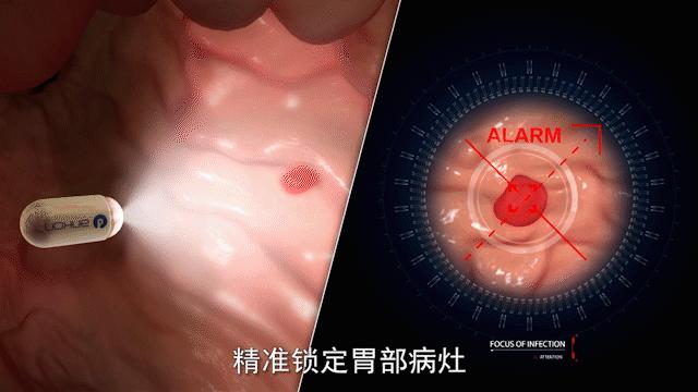 安翰磁控胶囊胃镜比国外好吗,安翰科技胶囊胃镜适用人群