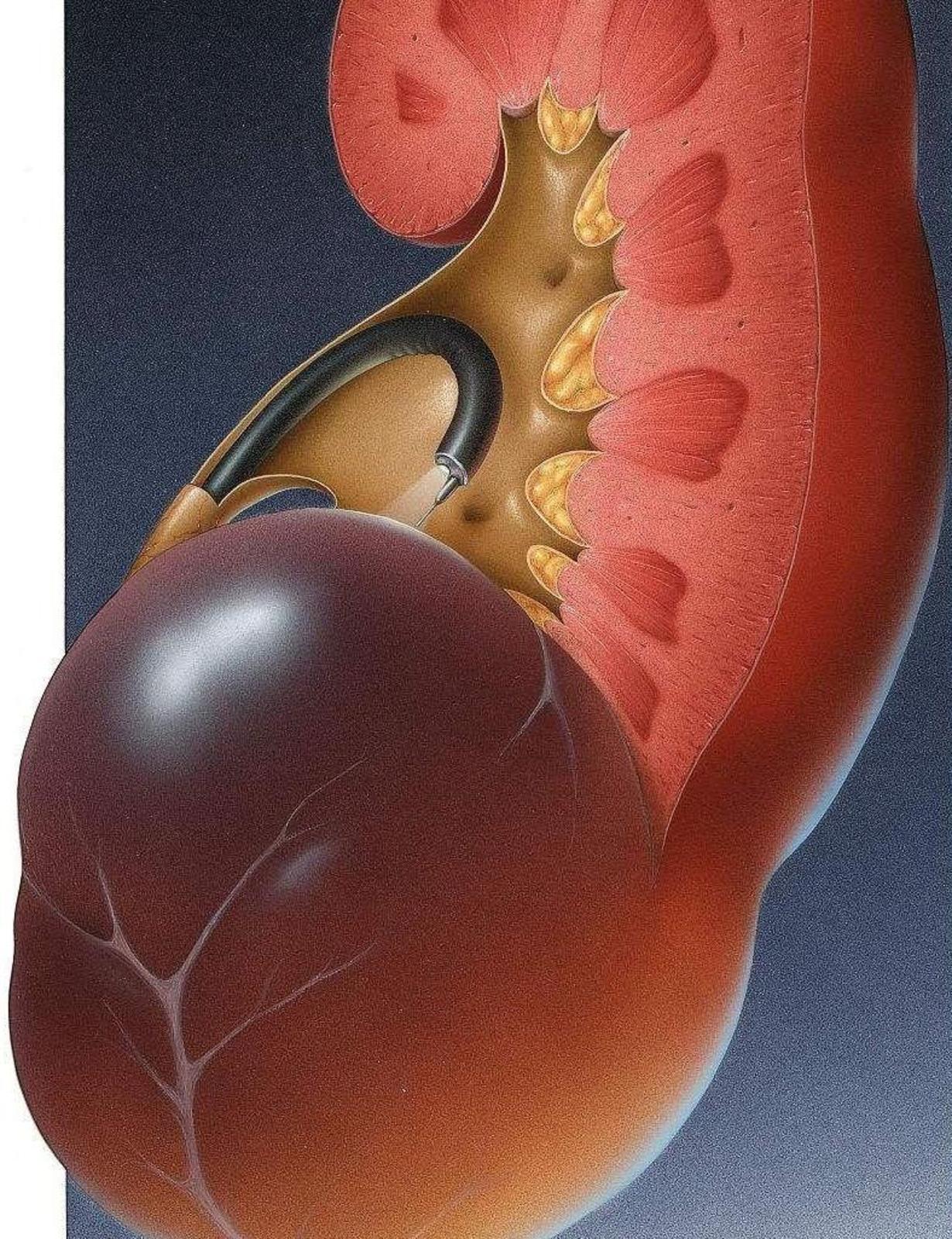 腹腔镜肾切除示意图,腹腔镜肾脏部分切除术