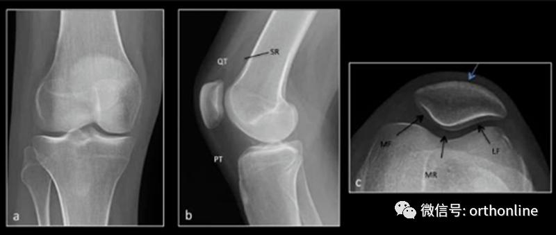 收藏膝关节康复8项锻炼方法,一招根治髌骨软化症的克星