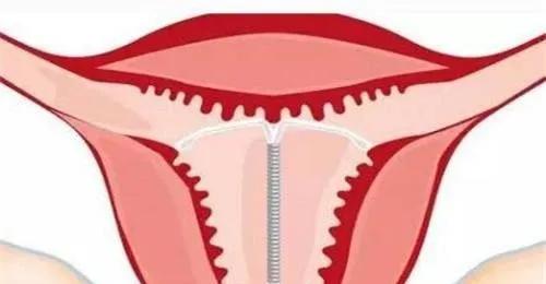 没有避孕的情况下怎么避孕,没有避孕如何防止不孕