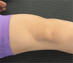 半月板损伤严重的状态是什么,半月板损伤应该注意什么问题