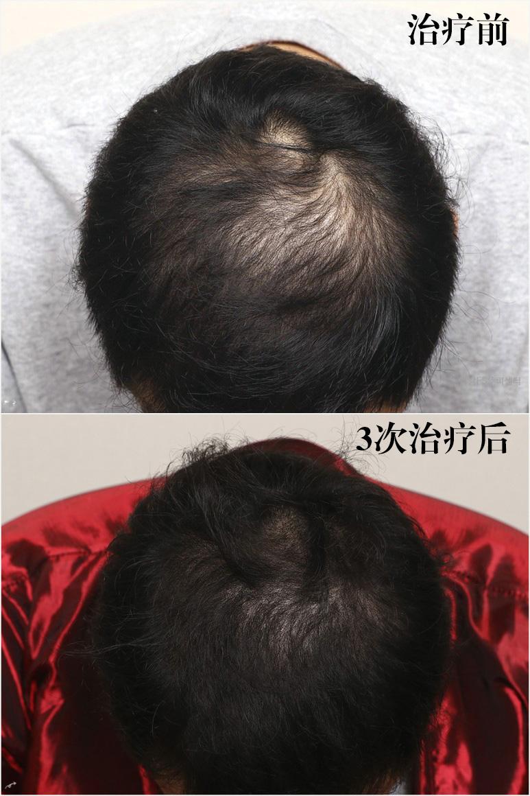 咋感觉越来越秃有没有生发小技巧 (20岁头发秃了通过药物可以生发吗)