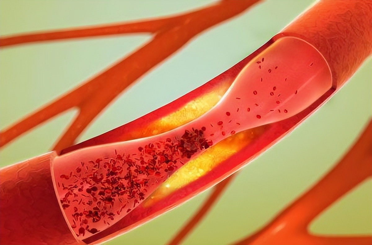 “打一针”治疗肝癌？湖北首例钇90微球治疗成功，花费或需30万