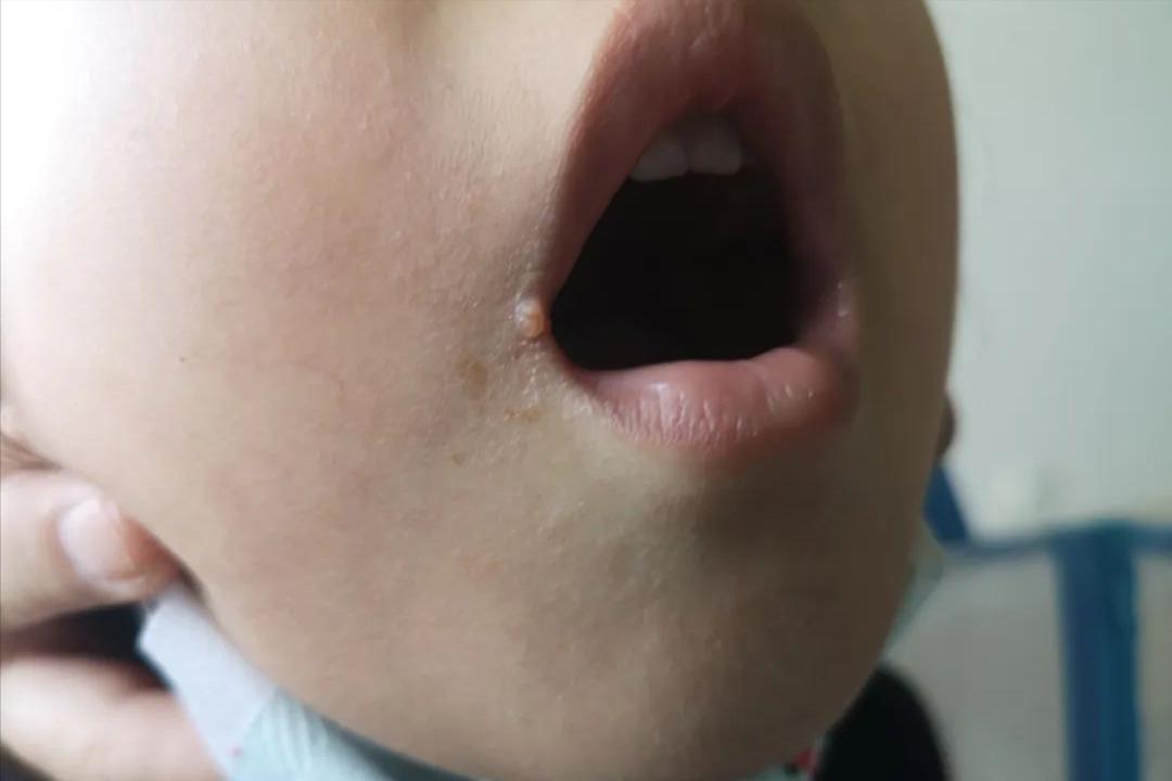 hpv和艾滋病怎么传染,hpv和疣有什么关系