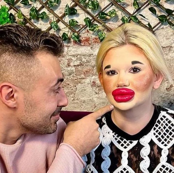 女子狂打30支玻尿酸,丰唇针建议打吗