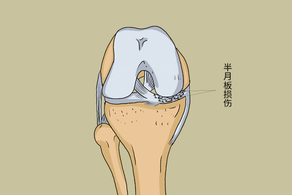 半月板撕裂疼痛怎么缓解,半月板三度撕裂怎么缓解疼痛