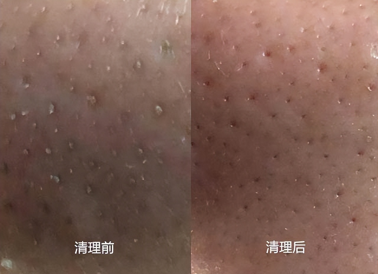 鼻头长黑粉刺怎么回事图片,鼻梁及两侧起了闭口粉刺