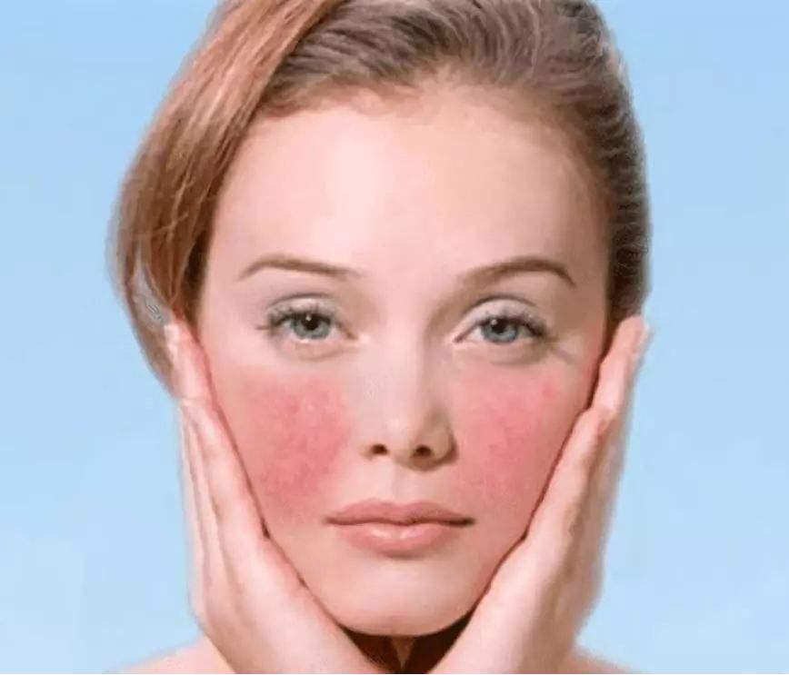 脸部皮肤过敏又红又疼,脸部皮肤过敏红瘙痒怎么办