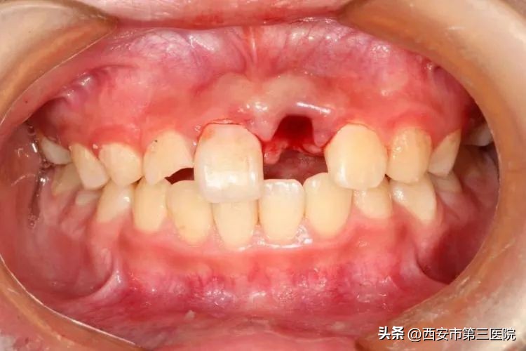 牙齿外伤的急救常识,科技之春三减三健