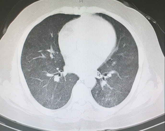 免疫缺陷病会并发什么病,什么是免疫缺陷肺部感染