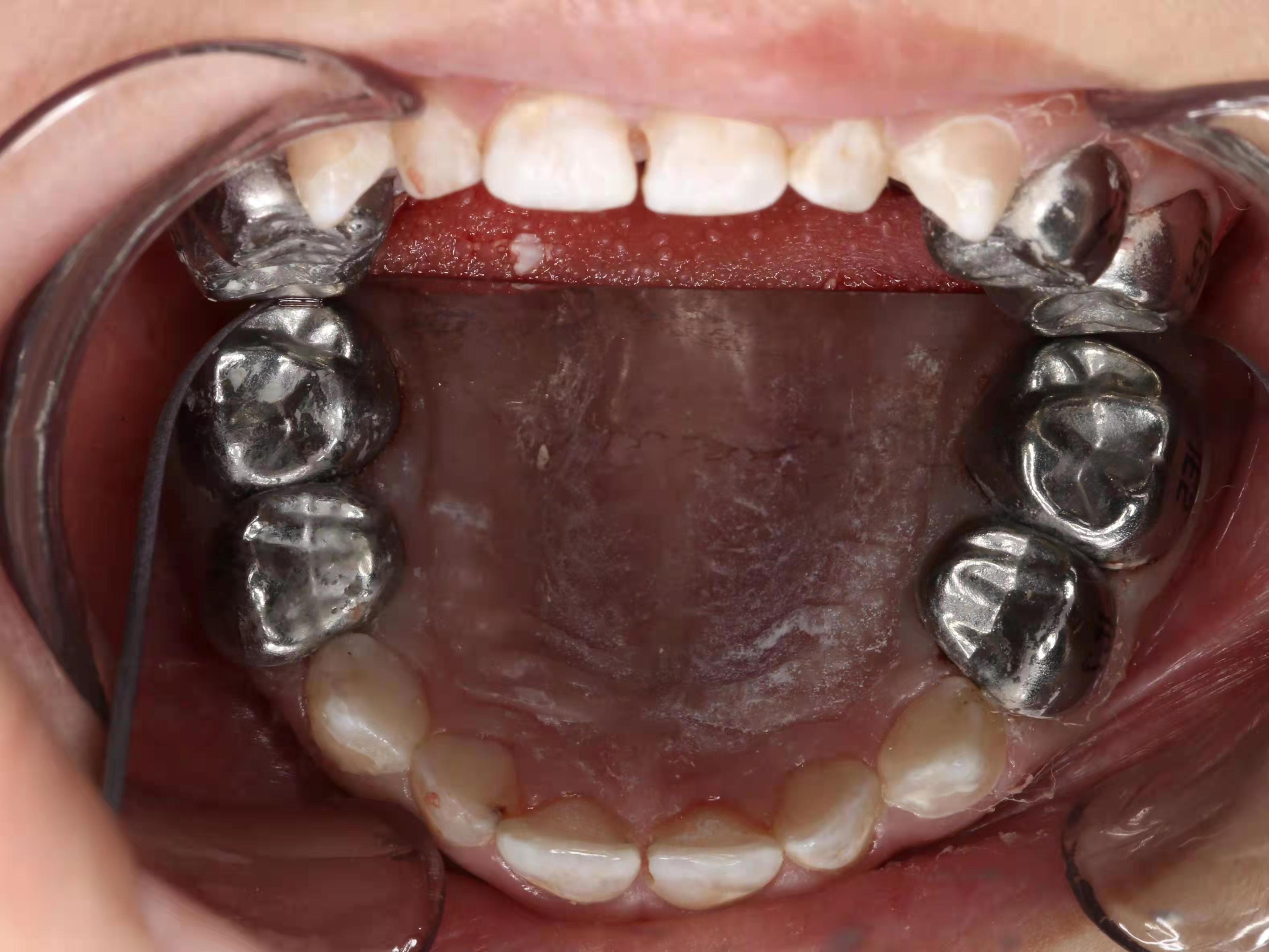 4岁女童竟有10颗蛀牙，协和金银湖院区“舒适医疗”打消嗜甜儿就医恐惧