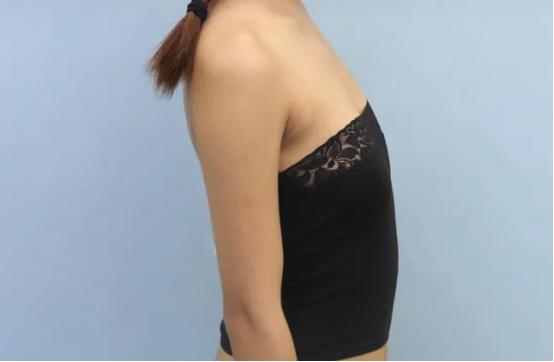 小胸假体丰胸方法,假体丰胸295cc扁平会太大吗