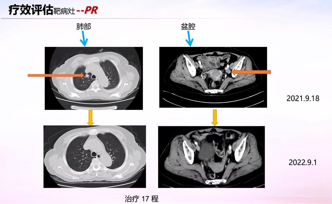 卡度尼利单抗宫颈癌晚期成功案例,宫颈癌复发卡度尼利单抗